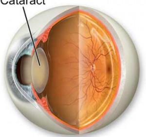 Comprehensive Cataract Treatment Services at Vision Eye Centre, Delhi