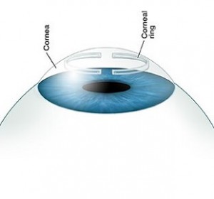 Cornea, Ocular Surface and Dry Eye Services